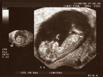 11 hafta bebeğin ultrason görüntüsü