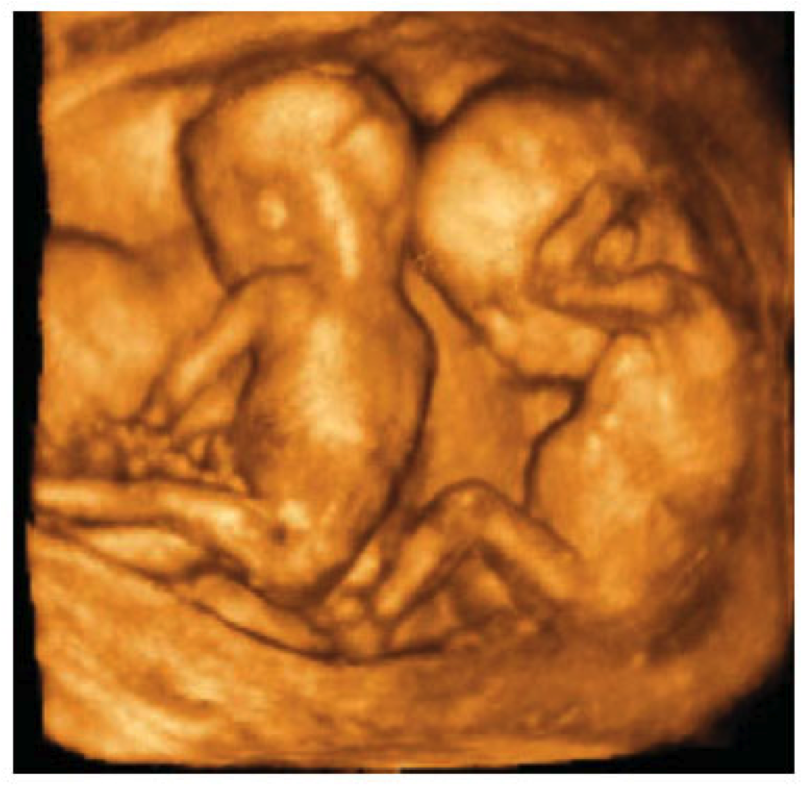 14 haftalık ikiz bebek görüntüsü