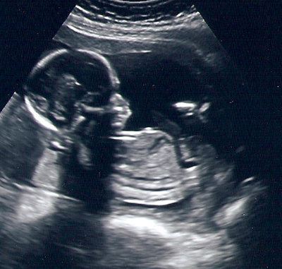 17 haftalik bebegin ultrason görüntüsü