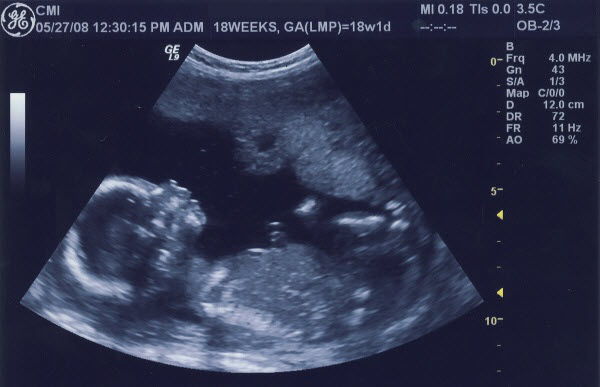 18 haftalik bebegin ultrason görüntüsü