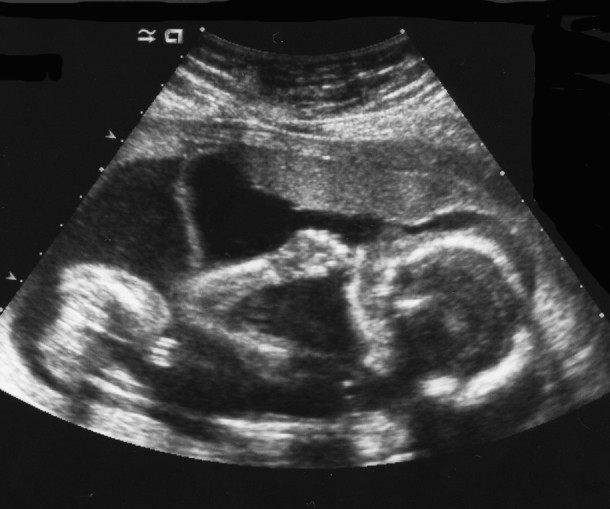 gebelikte 20. hafta bebek görüntüsü